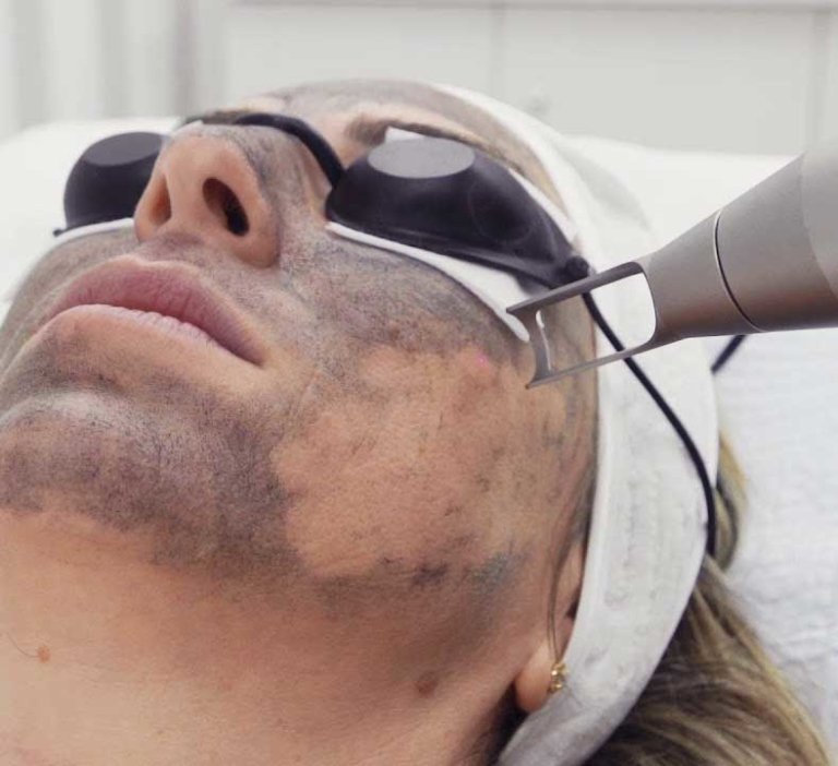 What Does A Carbon Laser Facial Do?
