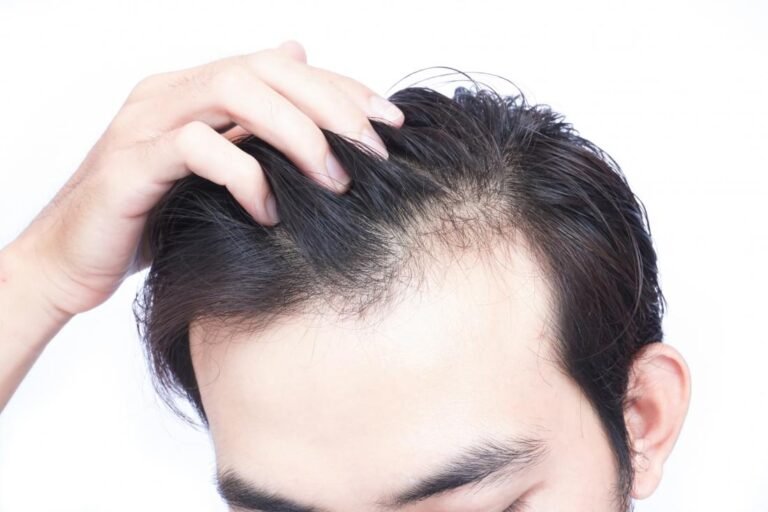 TOP 5 REASONS FOR HAIR LOSS