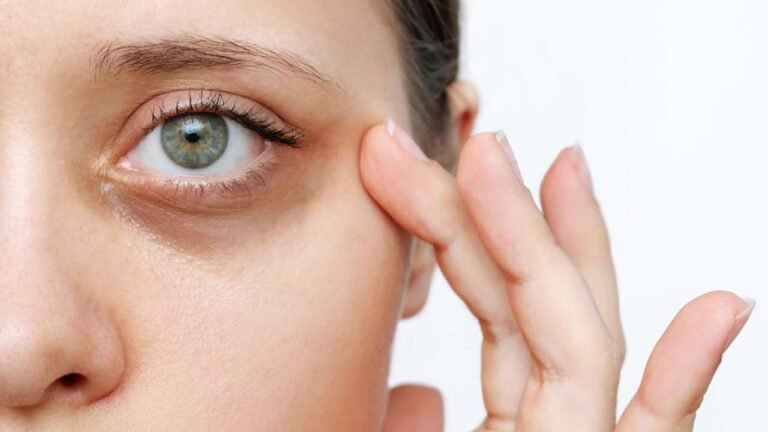 Dark Circles Under Eyes: Causes, Treatments, Results and Prevention Tips