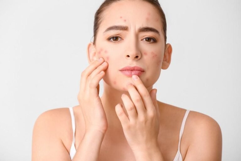 Foods That Cause Pimples: What to Avoid for Clear Skin