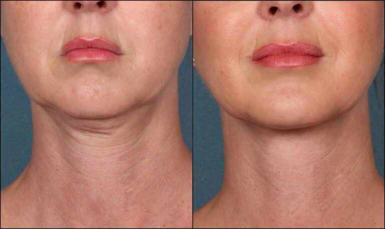 How Lasers Can Help Reduce Loose Skin and Wrinkles