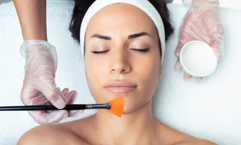 Chemical Peels for Acne: How They Work, Types, Benefits & Side Effects