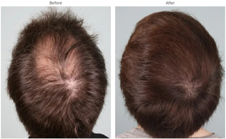 Top Myths and Facts About PRP Hair Loss Treatment