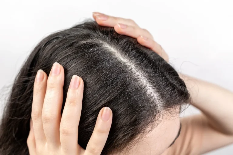 Dry Scalp and Hair Loss: Causes, Treatment, and Prevention