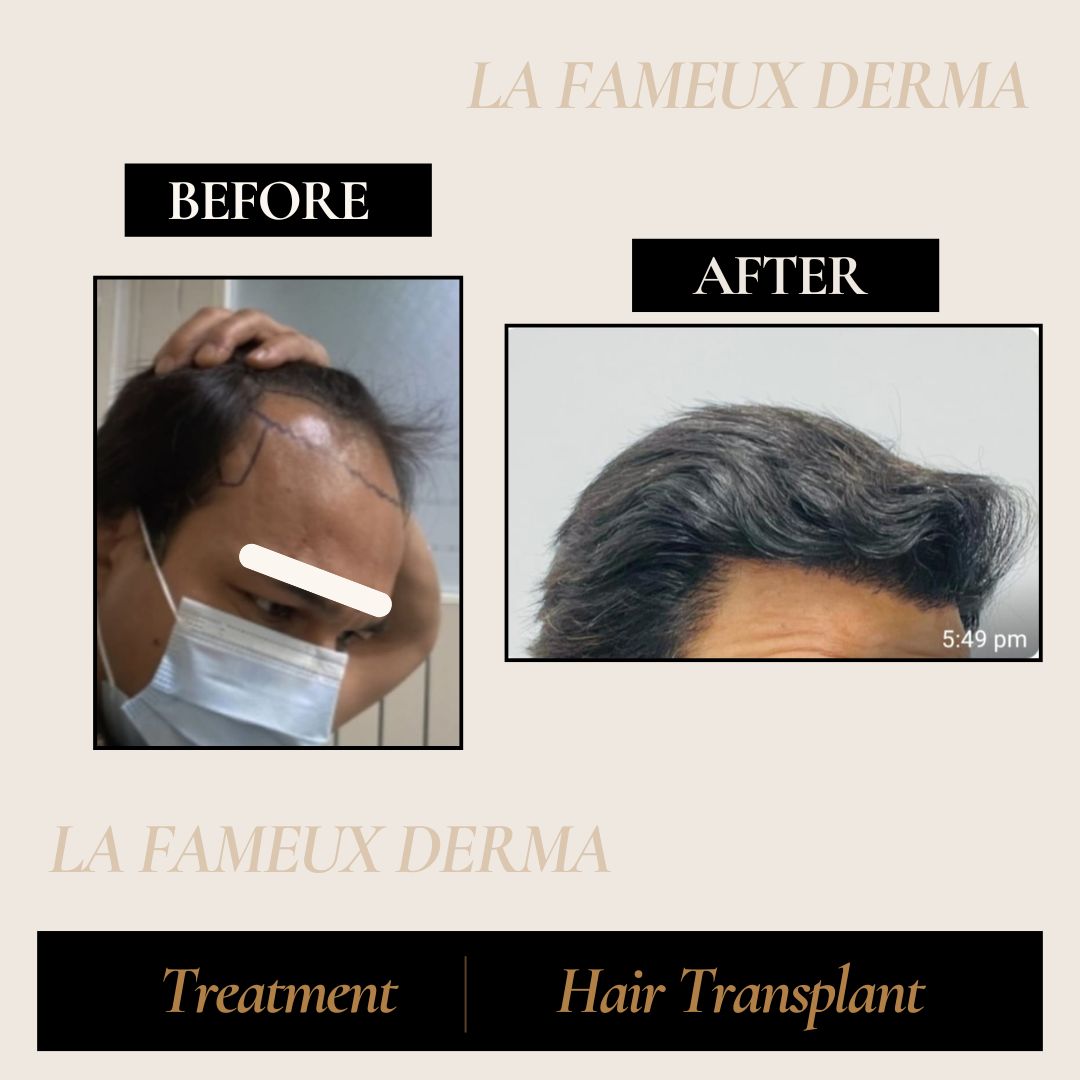 Neutral Before and After