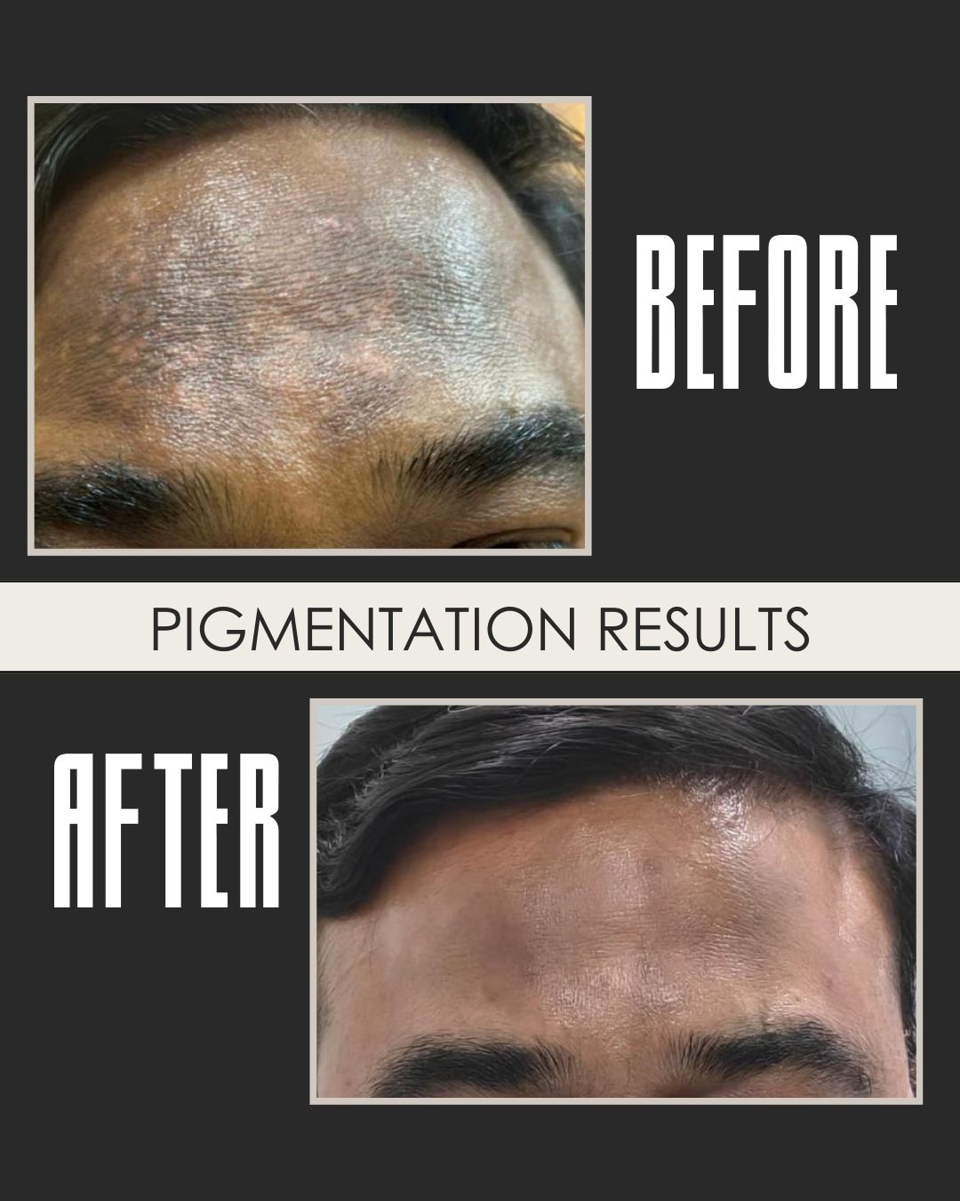 pigmentation results