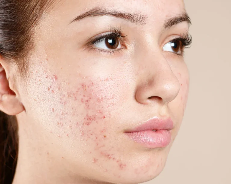 Best Acne Treatments in Noida – What Actually Works?