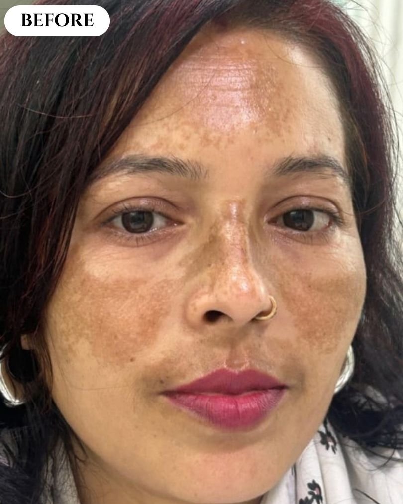 Stock image - skin treatment before