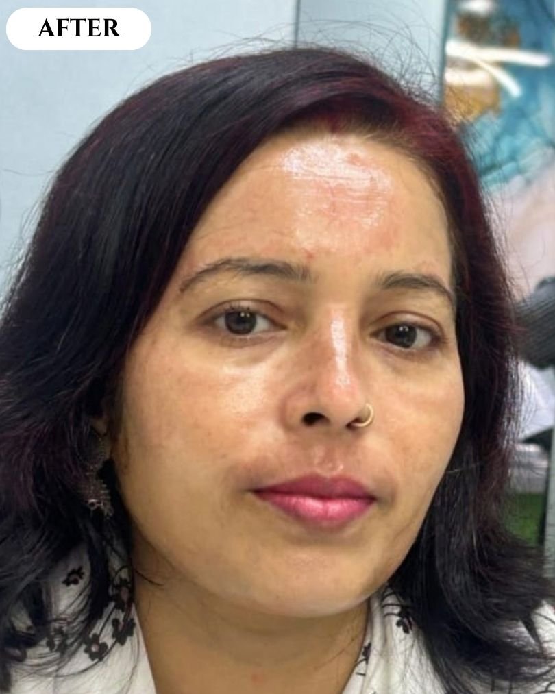 Stock image - skin treatment after