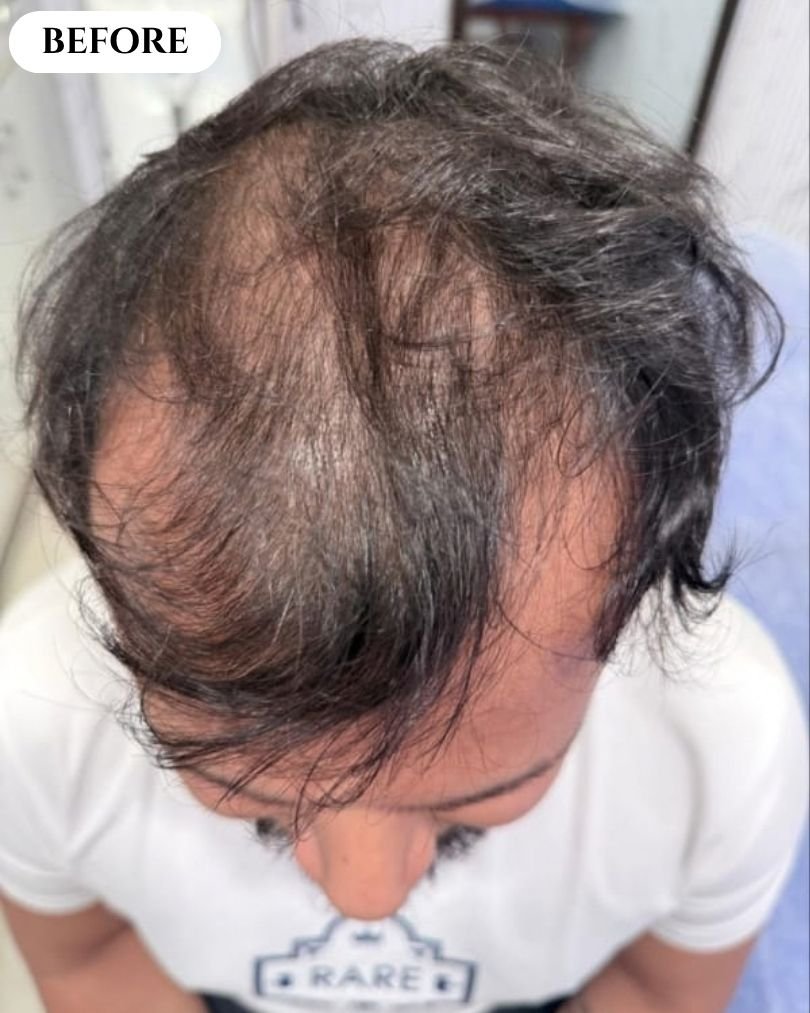 Stock image - hair restoration before