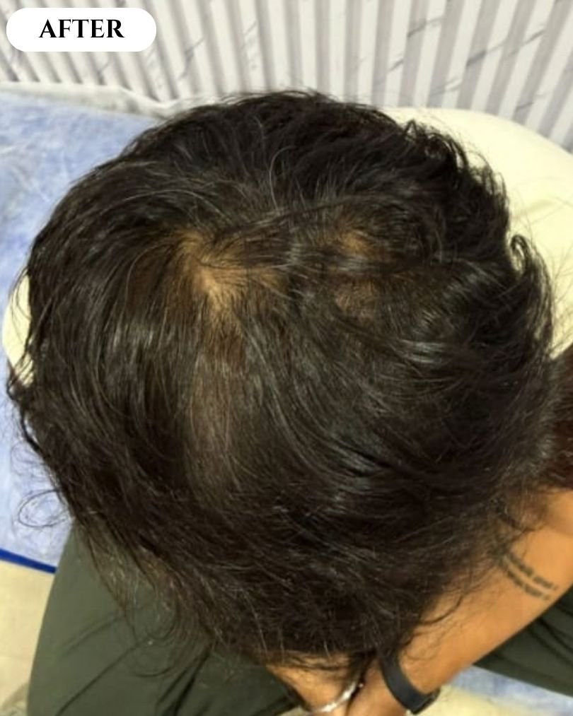 Stock image - hair restoration after