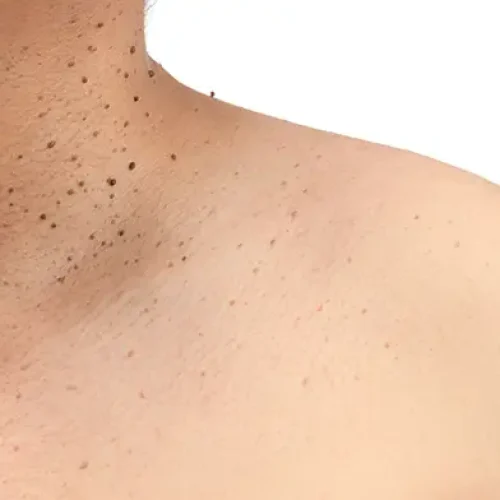 How to Remove Black Spots on Back and Neck: Effective Treatments & Home Remedies