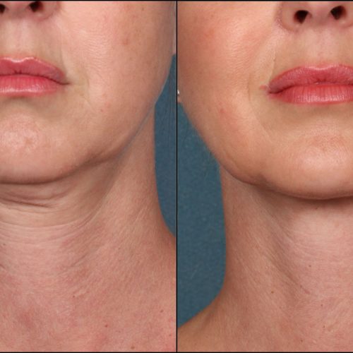 How Lasers Can Help Reduce Loose Skin and Wrinkles