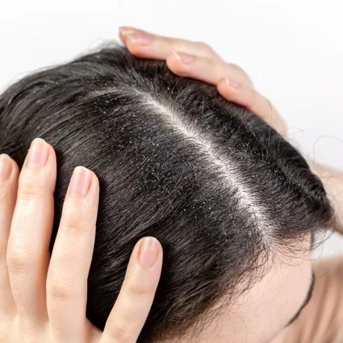 Dry Scalp and Hair Loss: Causes, Treatment, and Prevention