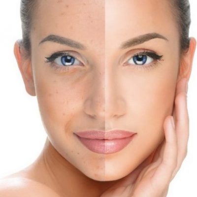 Face-Pigmentation