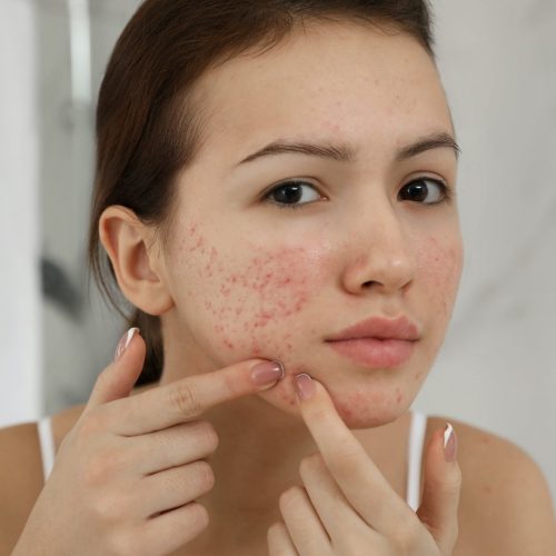 How to Get rid of Acne: Causes, Treatments and More