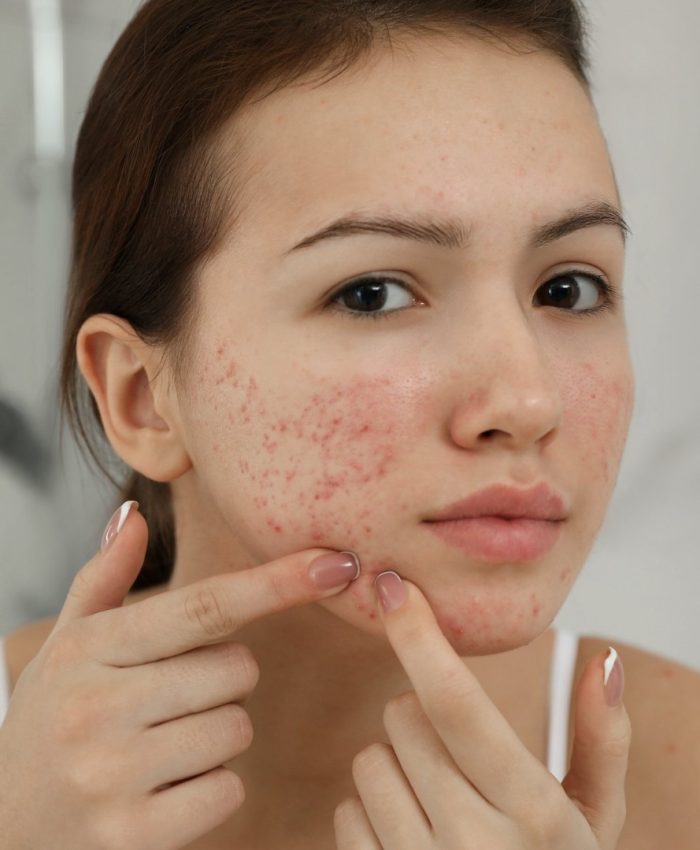 How to Get rid of Acne: Causes, Treatments and More