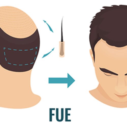 FUE Does Hair Grow Back In Donor Area?