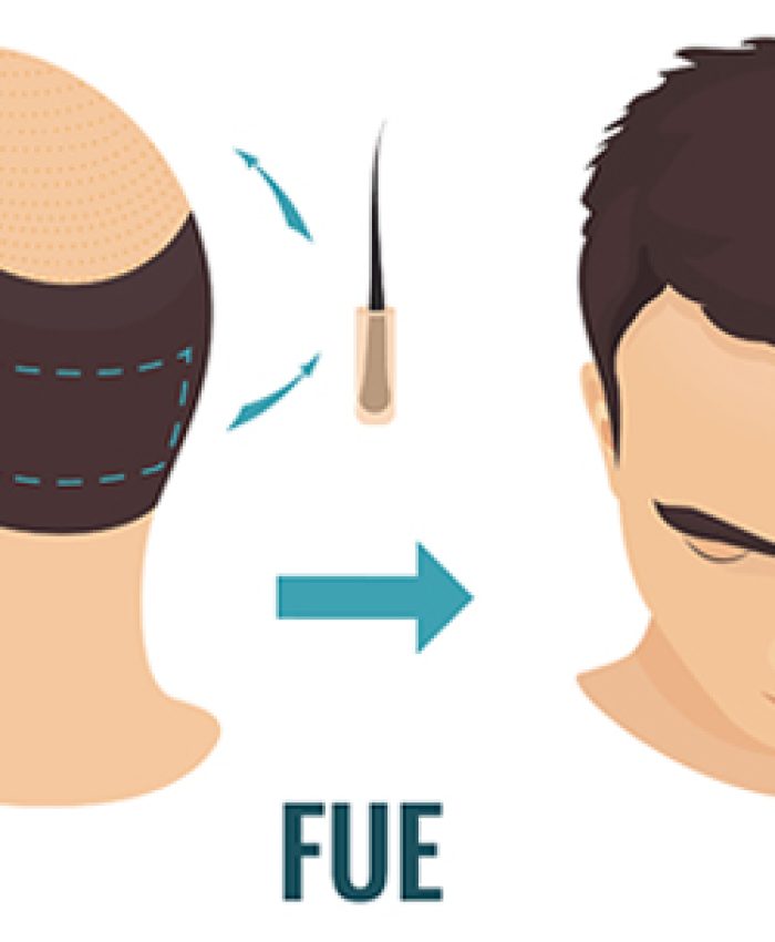 FUE Does Hair Grow Back In Donor Area?