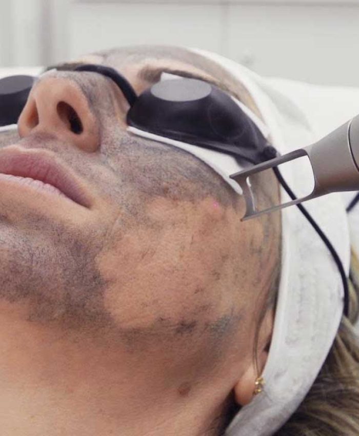 What Does A Carbon Laser Facial Do?