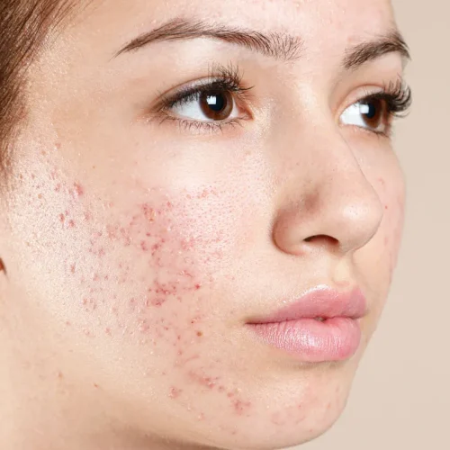 Best Acne Treatments in Noida – What Actually Works?