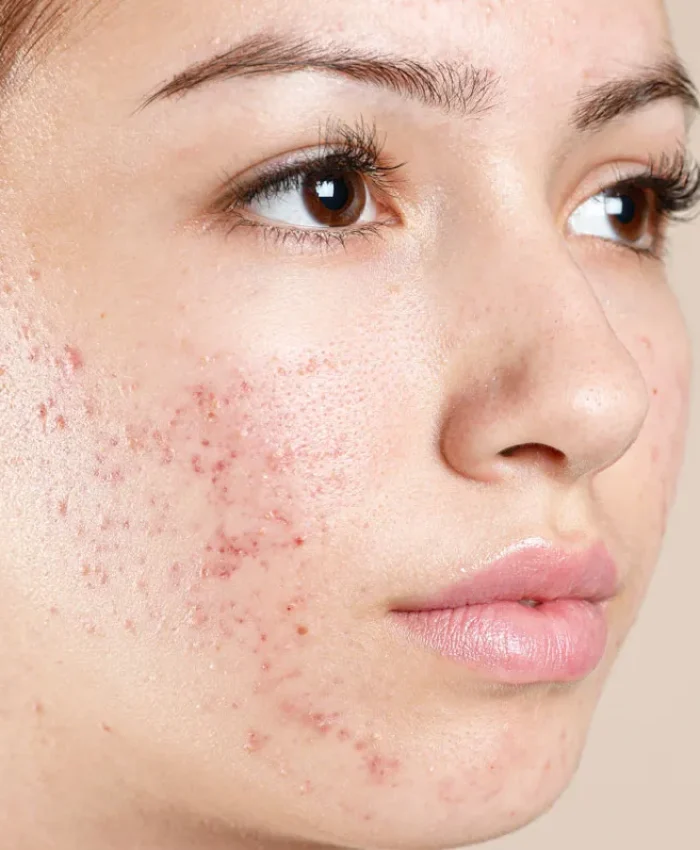 Best Acne Treatments in Noida – What Actually Works?