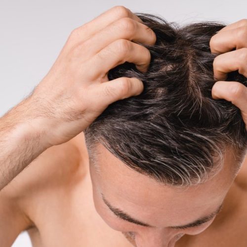 What Causes Hair Fall & How to Stop It?