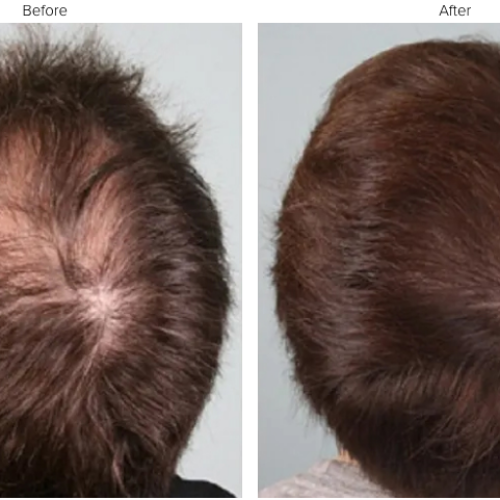 Top Myths and Facts About PRP Hair Loss Treatment