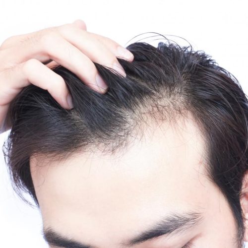 TOP 5 REASONS FOR HAIR LOSS