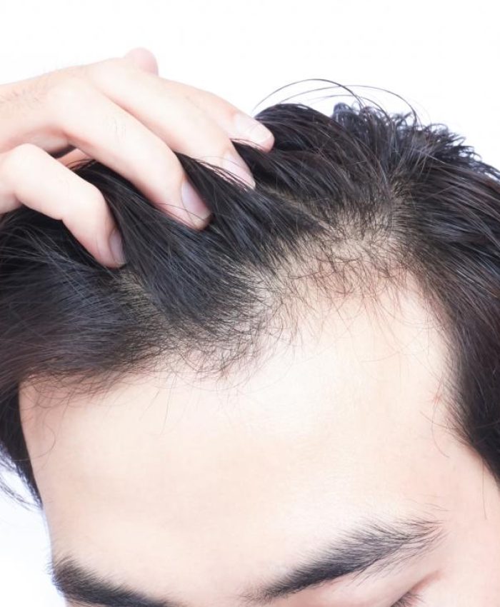TOP 5 REASONS FOR HAIR LOSS
